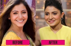Anushka-Sharma-before-and-after-plastic- surgery